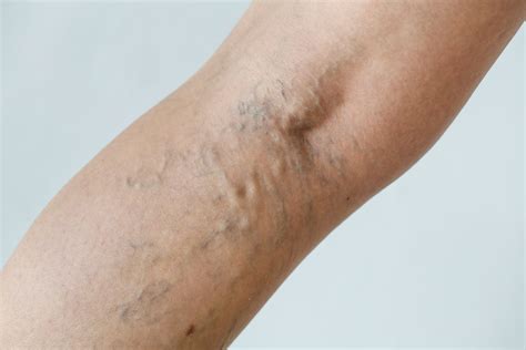 shoulder varicose veins tips  prevent spider veins melbourne