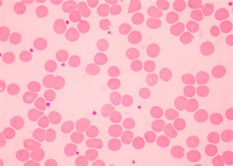 Felty Syndrome