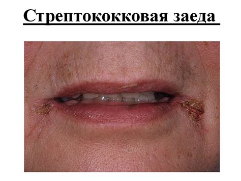 Пиодермии (гнойничковые заболевания кожи) - online presentation