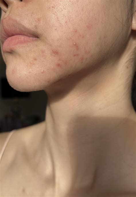 Outbreak of tiny white ‘pimples’ on chin and jaw since moving to UK : r