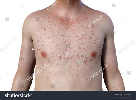 Dengue Hemorrhagic Fever Rash