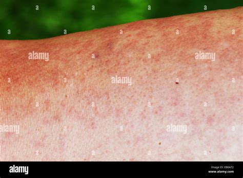 Maladies dermatologiques Banque de photographies et d’images à haute ...