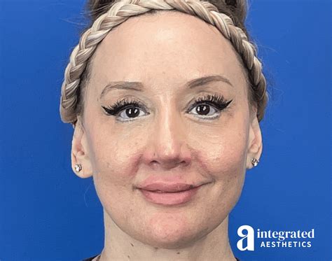 chemical face peel before and after 3