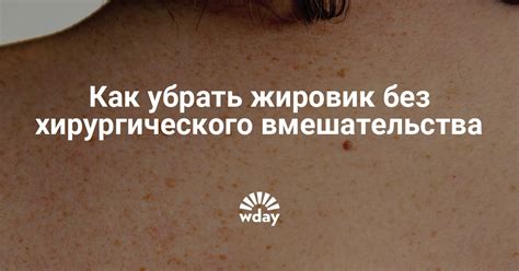 Как убрать жировик в домашних условиях | WDAY