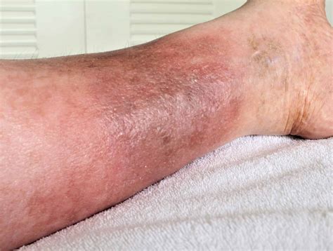 cellulitis symptoms  pictures  treatment vrogueco