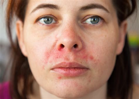 Perioral & Periorificial Dermatitis
