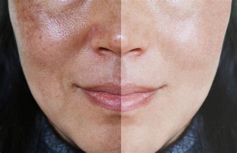 Entenda como surge o melasma e como tratar esse problema - Dra. Lia ...