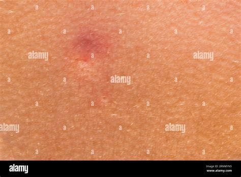 close-up of an insect bite on the skin. Allergic reaction. Skin ...