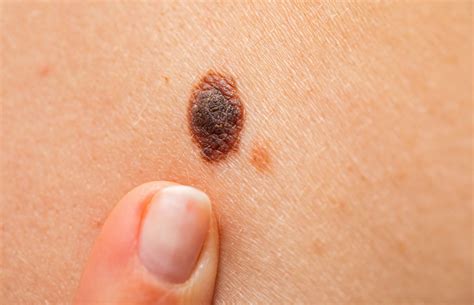 how to know if mole is cancerous