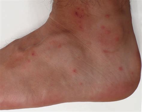 Mosquito Bites Vs Flea Bites