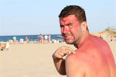how to know if sunburn is severe