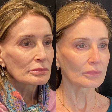 Liquid Face Lift - Clarity Medical Aesthetics