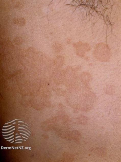 Pityriasis Versicolor, Causes, Symptoms, Diagnosis,, 43% OFF