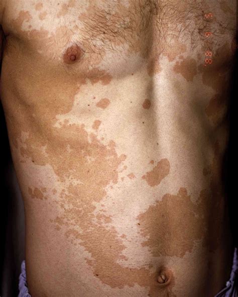What Causes White Spots On Skin That Won T Tan Reddit - Infoupdate.org