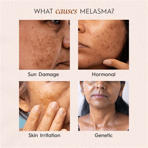 melasma cancer skin discoloration