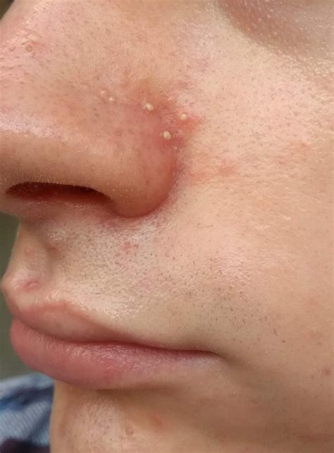 [Acne] Itchy, sore and red around nose with pustules. What's going on ...