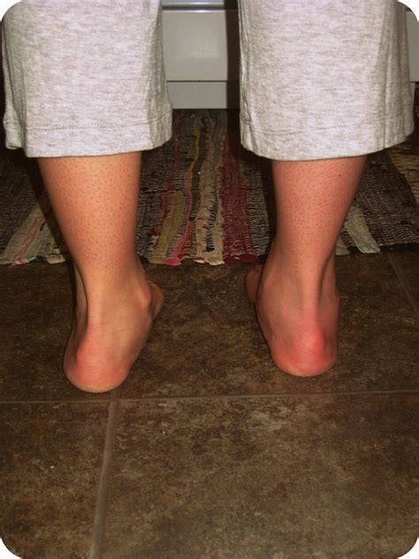 life after a calcaneus fracture surgery - Deana Givens