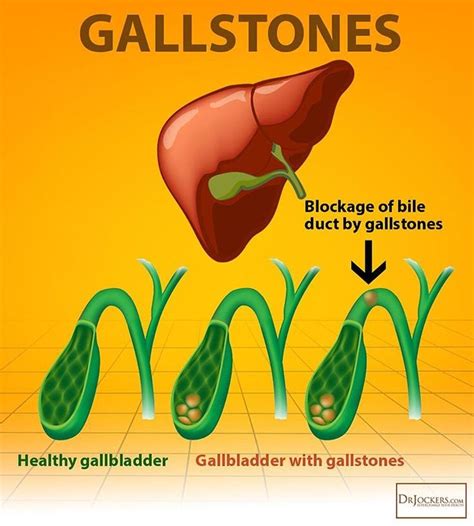 gallstones  crystalline formations  cholesterol  calcium formed