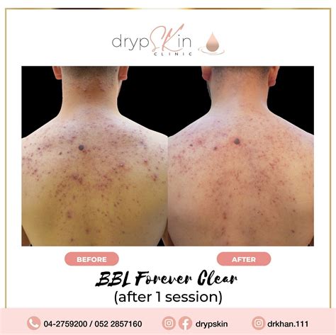 BBL Laser Dubai | BBL Forever Young - Drypskin