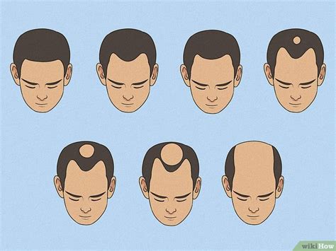 How to Tell if Your Hairline is Receding: Signs & Treatment