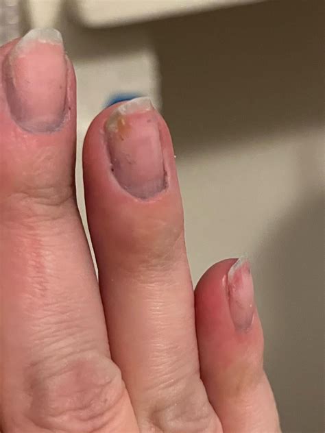 What Causes Bruised Nail Beds at Sarah Scoggins blog