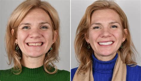 Explore the process of designing smiles using Digital Smile Design ...