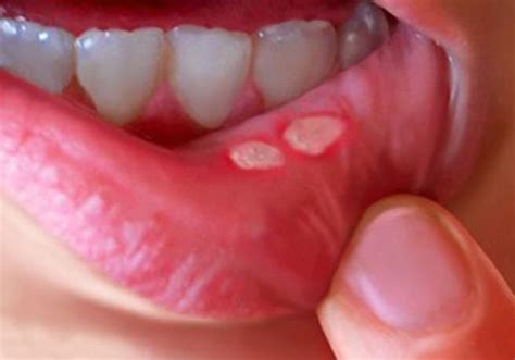 treatment  mouth ulcers  comprehensive guide archyde