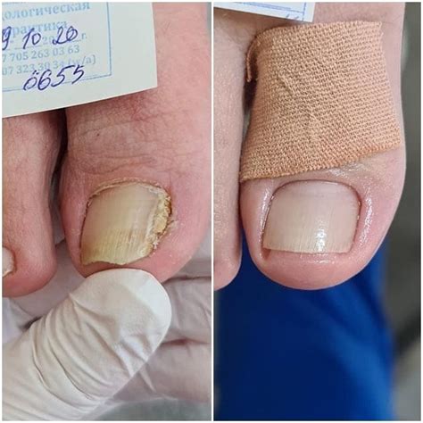 Центры лечения грибка ногтей | Подолог в Алматы