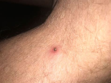 Tick Bite Infection