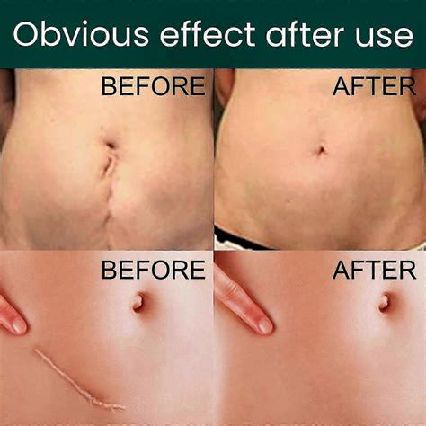 tattoo cover scar tummy tuck 7