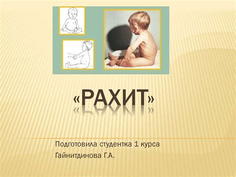 Рахит у детей - презентация онлайн