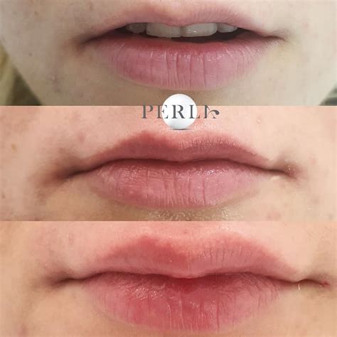 Perla Center - Dental & Facial Aesthetic Center - Постепено зголемување ...