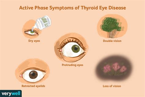 Graves Disease Eyes Treatment