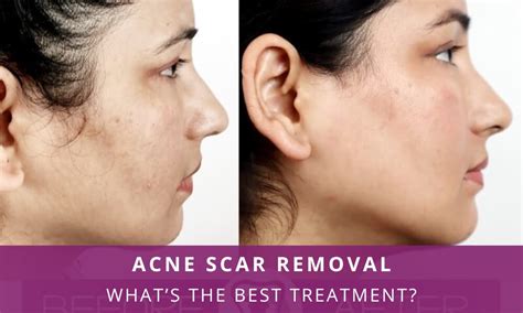 Acne Scar Removal: What’s the Best Treatment? – Richardson's Plastic ...