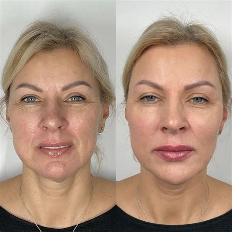 full face sculptra before and after 8