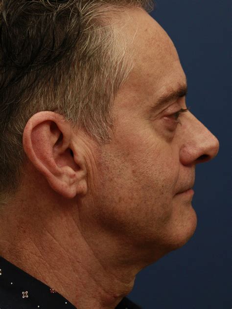 neck lower face lift 13