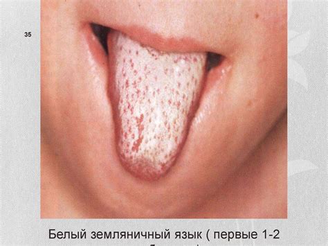Скарлатина. Этиология. Патогенез - презентация онлайн
