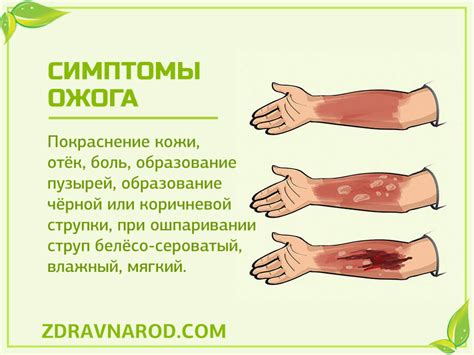Ожог | Народная медицина