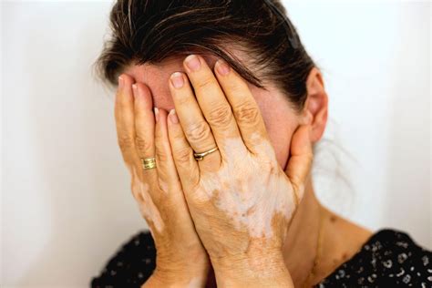 penyebab bercak putih  kulit   menghilangkannya honestdocs