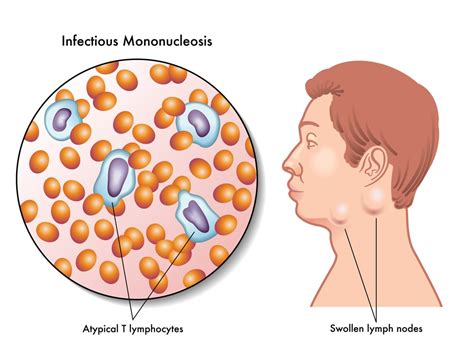 Mono (Infectious Mononucleosis) : Overview, Causes, Symptoms, Treatment ...