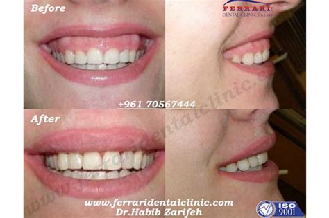 Labial Frenectomy Before And After