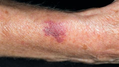 Senile or Actinic Purpura: Vitamin K, Natural Remedies, and Treatments