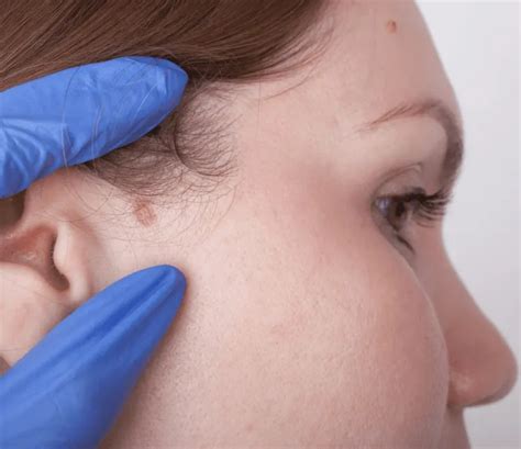 Boutons cancer de la peau: acrochordons ou mélanomes ! Comment ...