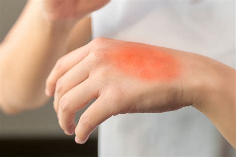 Queimadura De Gongolo O Que Fazer - Quais são os Primeiros Socorros para as queimaduras? | CliniGuia