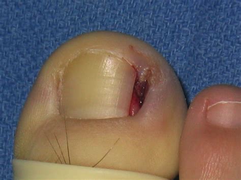 Ingrown Toenail Removal Aftercare