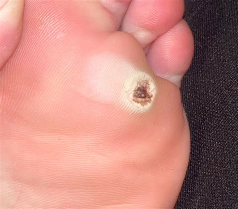 how to know when plantars wart is gone