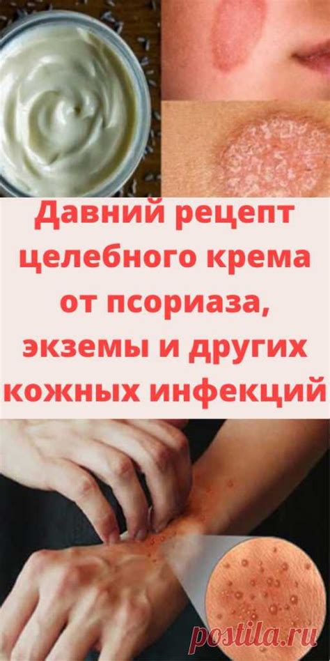 Давний рецепт целебного крема от псориаза, экземы и других кожных инф ...