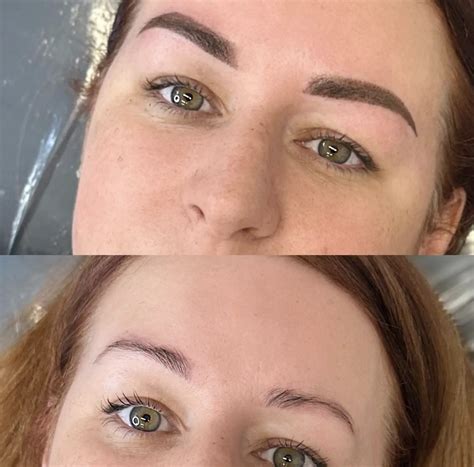 Saline Tattoo Removal: Can You Do It at Home Safely?