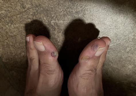 Toe blisters causes : r/RunningShoeGeeks