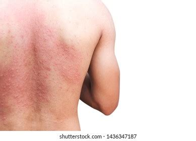 Man Skin Rash On Back Stock Photo 1436347187 | Shutterstock